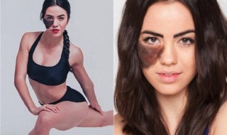 syntymämerkki-kasvoilla-nainen-kaunis-ei-ole-este