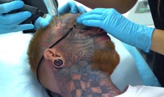 tatuointi-poisto-sketsi